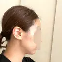 脂肪吸引（顔） / ボトックス（エラ・小顔） Mods Clinic（モッズクリニック） 東京院 DAY 36 サムネイル用
