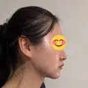 脂肪吸引（顔） / ヒアルロン酸注入（あご） HAAB×DREAM BEAUTY CLINIC 東京本院 DAY 19 サムネイル用