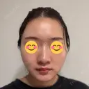 脂肪吸引（顔） / ヒアルロン酸注入（あご） HAAB×DREAM BEAUTY CLINIC 東京本院 DAY 19 サムネイル用