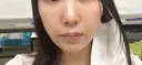 脂肪溶解注射（顔） Nクリニック伏見 AFTER サムネイル用
