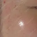 ピーリング（ニキビ・毛穴） / ルメッカ ルラ美容クリニック 大宮院 / ルラスキンクリニック 大宮院 DAY 2 サムネイル用
