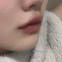 ヒアルロン酸注入（涙袋） / ヒアルロン酸注入（唇） / ボトックス（口角） ルラ美容クリニック 札幌本院 AFTER サムネイル用