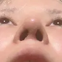 斜鼻修正 / プロテーゼ除去 / 鼻修正 / 鼻孔縁下降 / 鼻中隔延長（非切開） / 鼻柱挙上 HANABI整形外科 DAY 14 サムネイル用