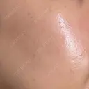 ルメッカ ルラ美容クリニック 静岡院 DAY 3 サムネイル用