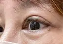 ピコスポット 博多もへじのクリニック DAY 6 サムネイル用