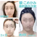 額を丸く クリニックビューティー恵比寿 AFTER サムネイル用