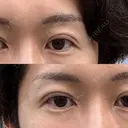 二重埋没 けやき美容クリニック 沼津院 DAY 0 サムネイル用