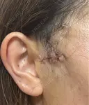 切開リフト / ワキ汗治療（切開） 石倉クリニック 水戸院 DAY 5 サムネイル用