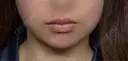 脂肪吸引（顔） ネビュラクリニック 京都院 DAY 11 サムネイル用