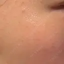 ピーリング（ニキビ・毛穴） / ルメッカ ルラ美容クリニック 大宮院 / ルラスキンクリニック 大宮院 DAY 5 サムネイル用