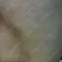 ショッピングリフト BAO CLINIC 梅田院 DAY 10 サムネイル用