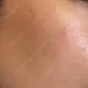 ルメッカ ルラ美容クリニック 静岡院 DAY 5 サムネイル用