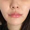 ピーリング（ハリ・ツヤ） FIG CLINIC DAY 1 サムネイル用