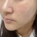 ピーリング（ニキビ・毛穴） 渋谷美容外科クリニック 横浜院 AFTER サムネイル用