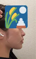 ボトックス（エラ・小顔） / ボトックス（口角） 銀座TAクリニック AFTER サムネイル用