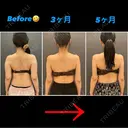 脂肪吸引（二の腕） / 脂肪吸引（背中） オアシス美容外科 AFTER サムネイル用