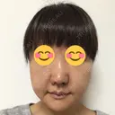 鼻尖形成（切開） / 小鼻縮小（切開） / 鼻尖縮小 湘南美容クリニック 神戸院 DAY 21 サムネイル用