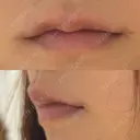 ヒアルロン酸注入（唇） / ボトックス（口角） ルラ美容クリニック 大阪心斎橋院 DAY 0 サムネイル用