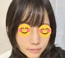 鼻尖形成（切開） / ワシ鼻修正・ハンプ切除 / 眉間プロテーゼ / 鼻柱下降・鼻唇角形成（猫手術） / ヒアルロン酸注入（額） グローバルビューティークリニック 大阪院 DAY 11 サムネイル用