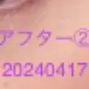 ボトックス（タレ目） / ボトックス（目尻） 品川美容外科 新宿院（※品川スキンクリニック提携） DAY 1 サムネイル用