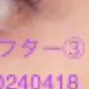 ボトックス（タレ目） / ボトックス（目尻） 品川美容外科 新宿院（※品川スキンクリニック提携） DAY 2 サムネイル用