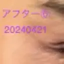 ボトックス（タレ目） / ボトックス（目尻） 品川美容外科 新宿院（※品川スキンクリニック提携） DAY 5 サムネイル用