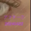 ボトックス（タレ目） / ボトックス（目尻） 品川美容外科 新宿院（※品川スキンクリニック提携） DAY 6 サムネイル用