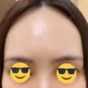 ピーリング（ハリ・ツヤ） FIG CLINIC AFTER サムネイル用