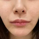 ピーリング（ハリ・ツヤ） FIG CLINIC DAY 4 サムネイル用