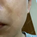 ショッピングリフト BAO CLINIC 梅田院 DAY 14 サムネイル用