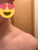 ボトックス（肩） / 高濃度ビタミンC点滴 小倉美容外科/美容皮膚科 ビラビューティークリニック DAY 2 サムネイル用