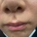 医療脱毛（顔） 新宿Ladies&Gentlemen美容クリニック AFTER サムネイル用