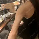 脂肪吸引（二の腕） アムルーズ美容外科クリニック 横浜院 DAY 410 サムネイル用