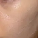 ルメッカ ルラ美容クリニック 静岡院 AFTER サムネイル用