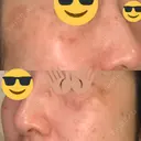 プラセンタ注射 / シミ取りレーザー 仁愛クリニック DAY 52 サムネイル用