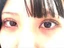 二重埋没 日本ウェルネス再生クリニック DAY 0 サムネイル用