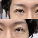 二重埋没 けやき美容クリニック 沼津院 DAY 7 サムネイル用