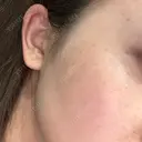 ルメッカ 東京美容外科 名古屋院 DAY 0 サムネイル用