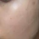 ルメッカ 東京美容外科 名古屋院 AFTER サムネイル用