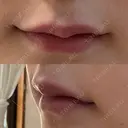 ヒアルロン酸注入（唇） / ボトックス（口角） ルラ美容クリニック 大阪心斎橋院 DAY 2 サムネイル用