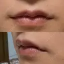 ヒアルロン酸注入（唇） / ボトックス（口角） ルラ美容クリニック 大阪心斎橋院 DAY 3 サムネイル用