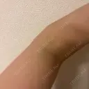 ボトックス（肩） / 高濃度ビタミンC点滴 小倉美容外科/美容皮膚科 ビラビューティークリニック DAY 3 サムネイル用