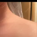 ボトックス（肩） / 高濃度ビタミンC点滴 小倉美容外科/美容皮膚科 ビラビューティークリニック DAY 3 サムネイル用