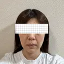 バッカルファット除去 アリエル美容クリニック 大宮院 DAY 14 サムネイル用