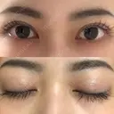 二重切開 ルネッサンス美容外科医院 神戸院 DAY 87 サムネイル用