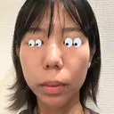 水光注射（ハリ・美肌） / マイクロボトックス DAILY SKIN CLINIC 心斎橋院 DAY 1 サムネイル用