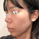 水光注射（ハリ・美肌） / マイクロボトックス DAILY SKIN CLINIC 心斎橋院 DAY 1 サムネイル用