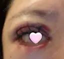 二重埋没 / 眼瞼下垂（切開） / 上まぶたの脂肪取り 藤・ナチュレ美容クリニック 銀座院 DAY 1 サムネイル用