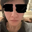 ボトックス（あご） / ボトックス（エラ・小顔） / ボトックス（口角） / ワキ汗治療（ボトックス） DMTC CLINIC 日本橋院 DAY 0 サムネイル用