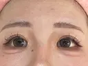 二重埋没 / 目頭切開 GRACIA clinic 【グラシアクリニック】 AFTER サムネイル用